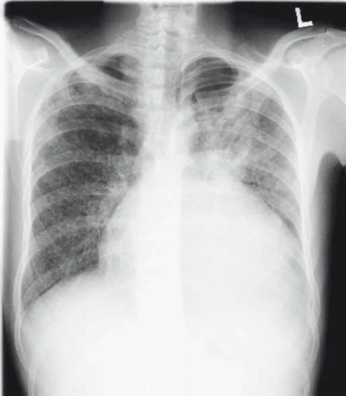Pacient, 25 let, s tuberkulózním postižením plic, perikardu a urogenitálního traktu před zahájením terapie antituberkulotiky.
Fig.1. A 25-year-old patient with lung, pericardial and urogenital tract tuberculosis before initiating anti-tuberculosis therapy.