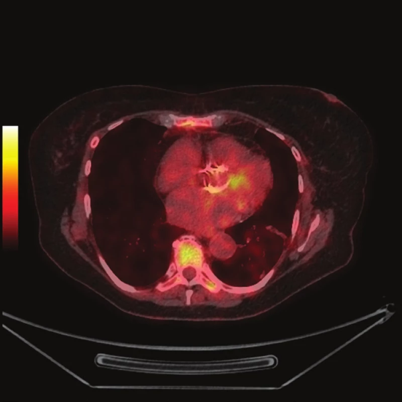 FDG PET/CT z 10.9.2012
1a - předozadní maximum intensity projection (MIP)
1b - PET s korekcí na atenuaci, axiální řez srdcem v úrovni aortálního anulu, je patrná diskrétně zvýšená akumulace FDG při aortálním anulu (šipka)
1c - PET bez korekce na atenuaci, ve stejné rovině jako 1b
1d - fúze PET/CT, ve stejné rovině jako 1b
