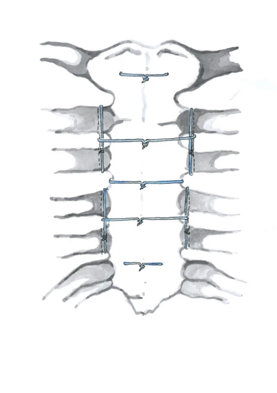 Robicsekova technika (Kresba archiv autora)
Fig. 7: Robicsek closure