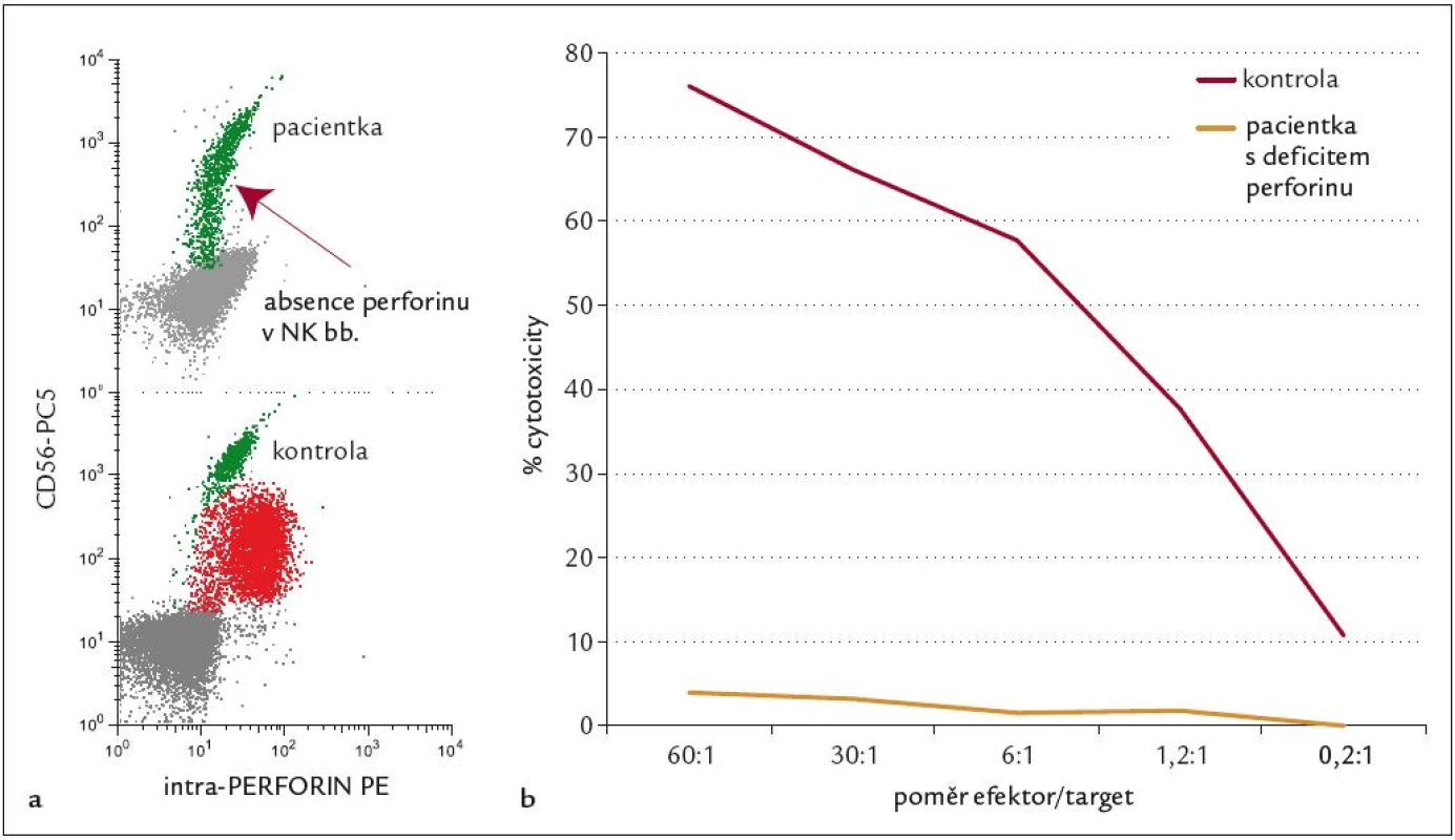 FHL – imunologická diagnostika.
6a: Průkaz defi citu perforinu v NK buňkách metodou FACS – absence signálu při dvoubarevné CD analýze u pacientky s FHL (řádek 1) ve srovnání se zdravou kontrolou (řádek 2).
6b: Patologický test cytotoxické funkce T lymfoblastů – významně defi citní odpověď u pacientky č. 1 ve srovnání ze zdravou kontrolou.