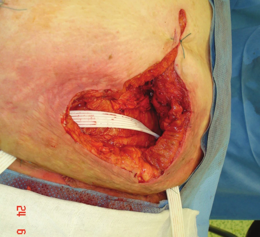 Pooperační snímek s excidovaným kožním krytem a drenáží, na spodině střechovitá plastika
Fig. 4. Postoperative view with removed skin cover and drainage