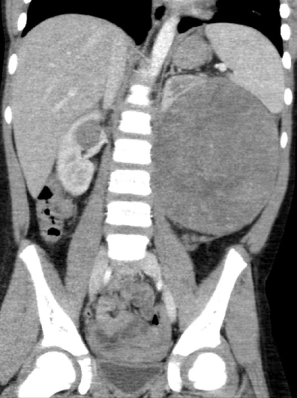 Bilaterální WT u šestileté pacientky
Fig. 4. Bilateral WT in a six year old patient