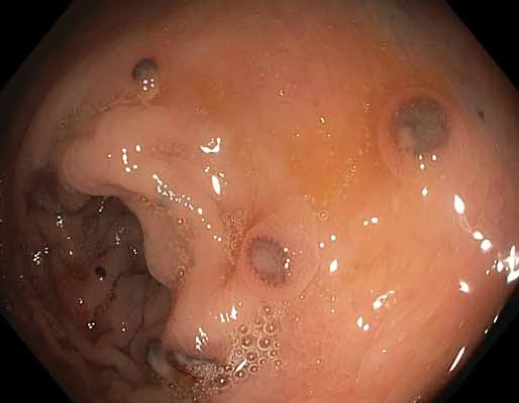Mnohočetné pigmentované noduly v tlustém střevě.
Fig. 1. Multiple pigmented nodules of the colon.