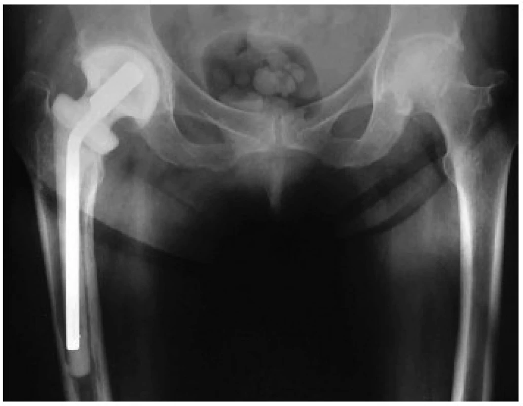 Rentgenový snímek implantovaného ready-made spaceru kyčelního kloubu
Významnou výhodou je zachování délky končetiny.
Fig 1. An X-ray of an implanted ready-made total hip spacer, having the advantage of preserving limb length