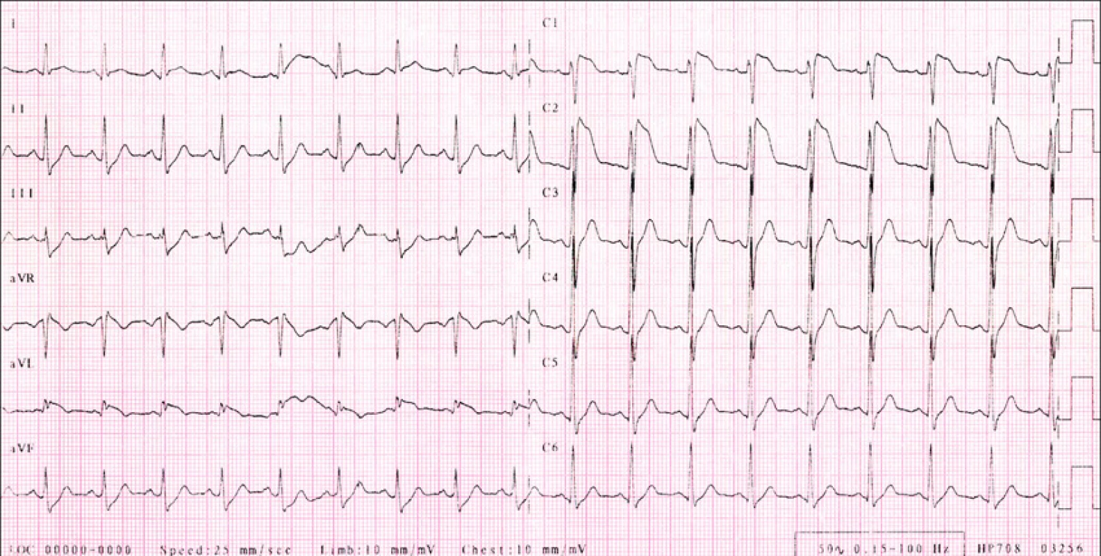 RK, 29 let, Brugada syndrom.
EKG s vysoko odstupujícími konkávními elevacemi ST segmentu (J vlna) ve V1,2.