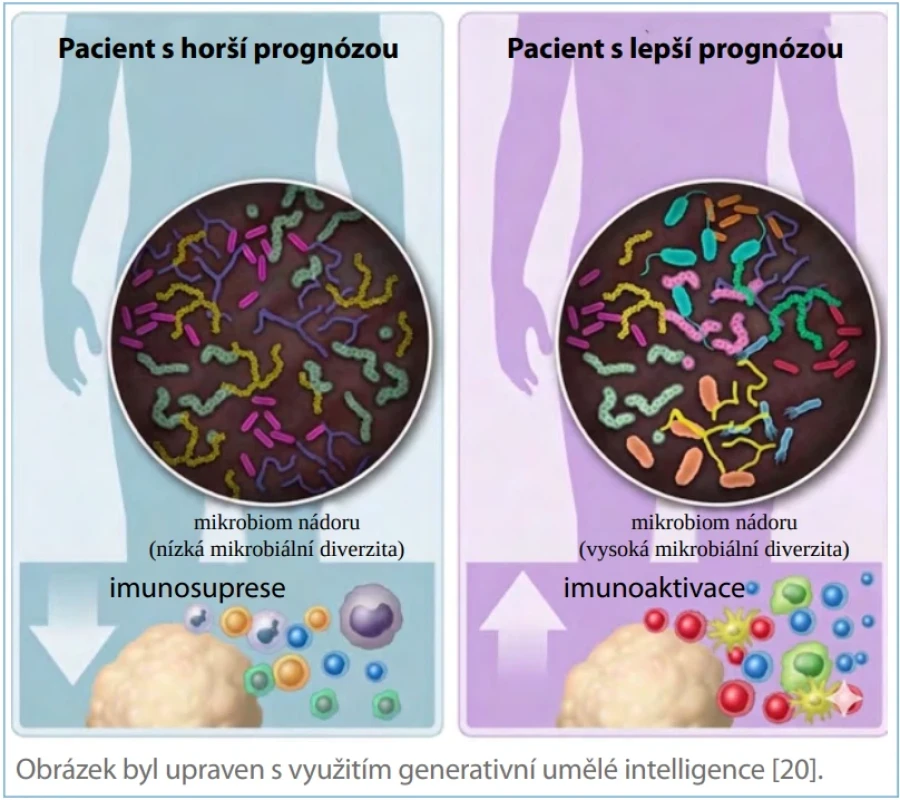 Schéma hypotetického vlivu intratumorálního mikrobiomu na imunitní mikroprostředí a klinickou prognózu u ccRCC dle Xu et al. [7]. Fig. 1. Schematic representation of the hypothetical impact of the intratumoral microbiome on the tumor immune microenvironment and clinical prognosis in ccRCC according to Xu et al. [7].