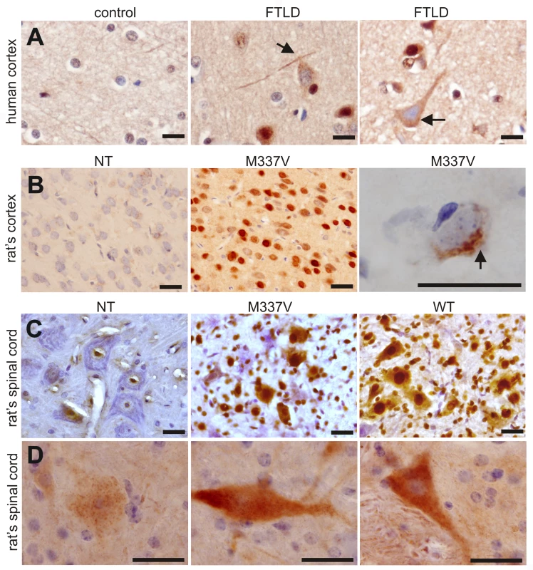 Phosphorylation and cytoplasmic localization of TDP-43 in FTLD patients and in <i>TDP</i> transgenic rats.
