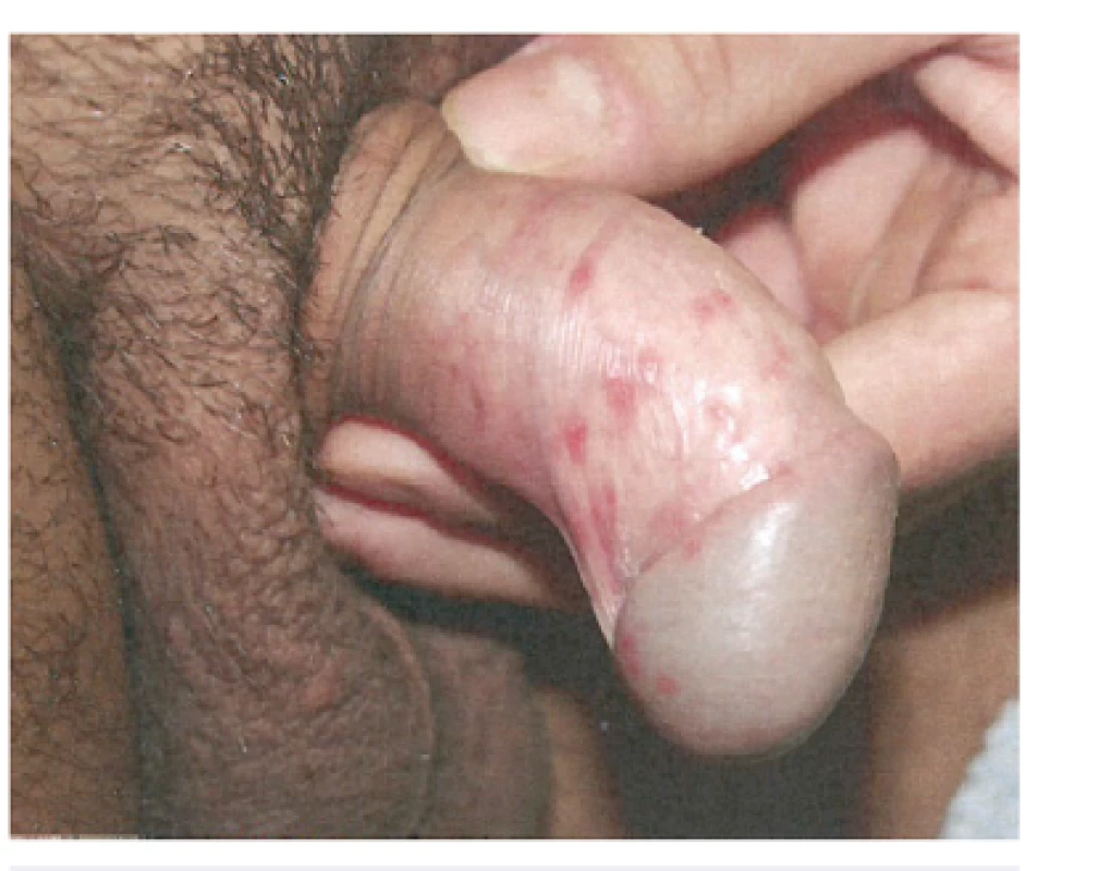 Herpes genitalis (použito se svolením prof. MUDr. K. Pizingera, CSc.)
Fig. 3. Herpes genitalis (used with permission of Prof. K. Pizinger, MD, PhD)