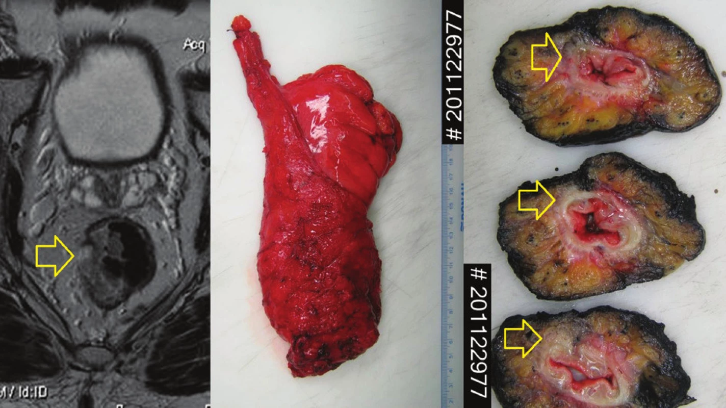 Diagnosticko-léčebná sekvence Vlevo MRI pacienta s lokálně pokročilým nádorem střední části rekta cTc, 3N1, cM0. Uprostřed makrofotografie resekčního výkonu, kvalita excize: kompletní, vpravo příčné řezy identifikující nádor: pT3, ypCRO negativní.
Fig. 2: MRI of localy advanced rectal cancer in a male patient cT3, cN1, cM0 (left) The macrophotography of resected specimen, mesorectal excision quality: complete. Axial sections of specimen in the same patient: ypT3, ypCRM negative.