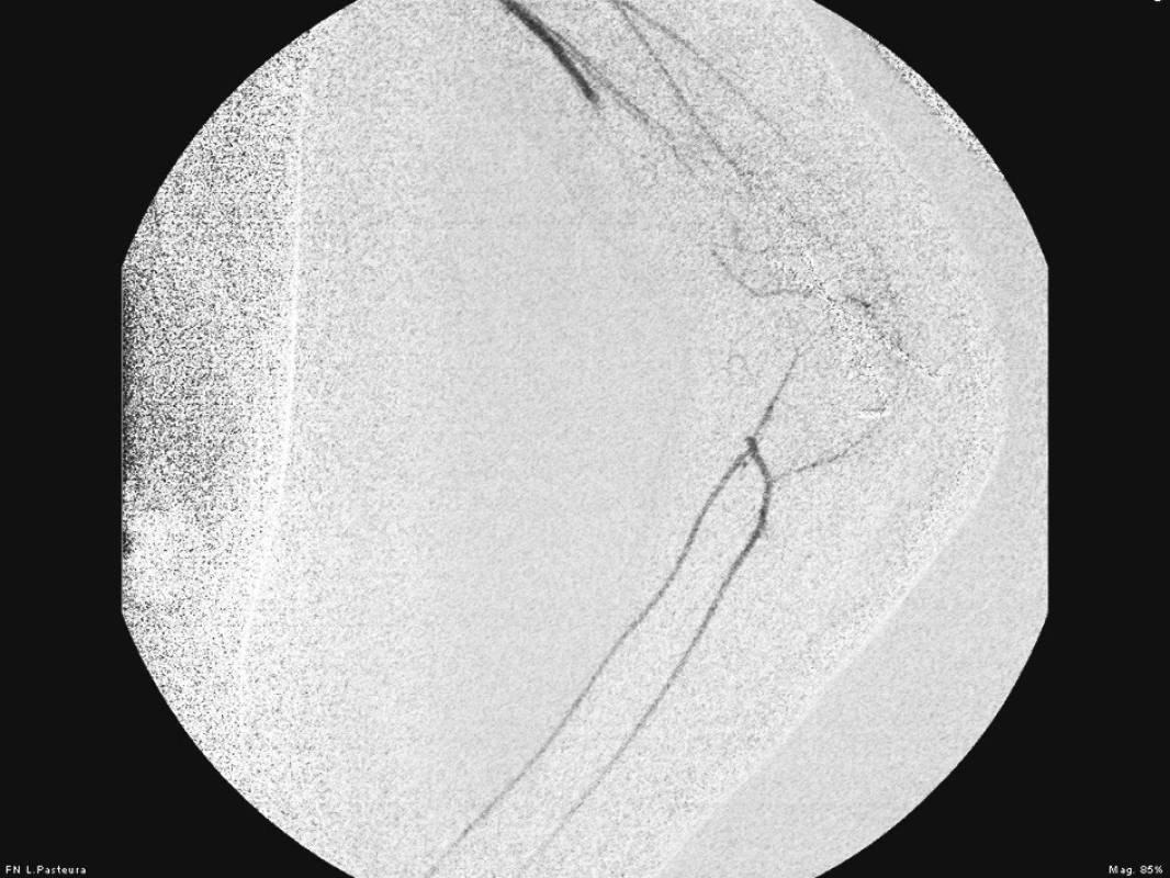 Prvotná poúrazová angiografia pred rekonštrukciou a. brachialis
Fig. 1. Initial posttraumatic angiography prior to the brachial artery reconstruction