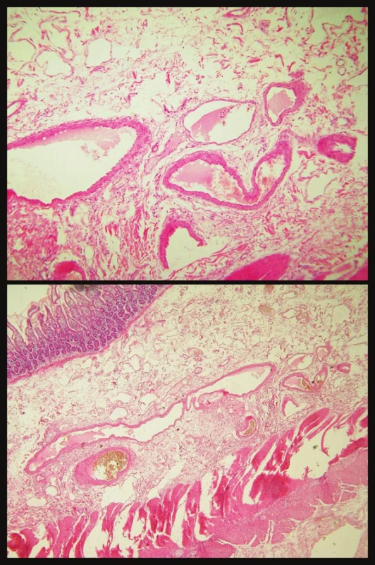 Histologický obraz angiodysplázie
Fig. 3. Histological view of angiodysplasia