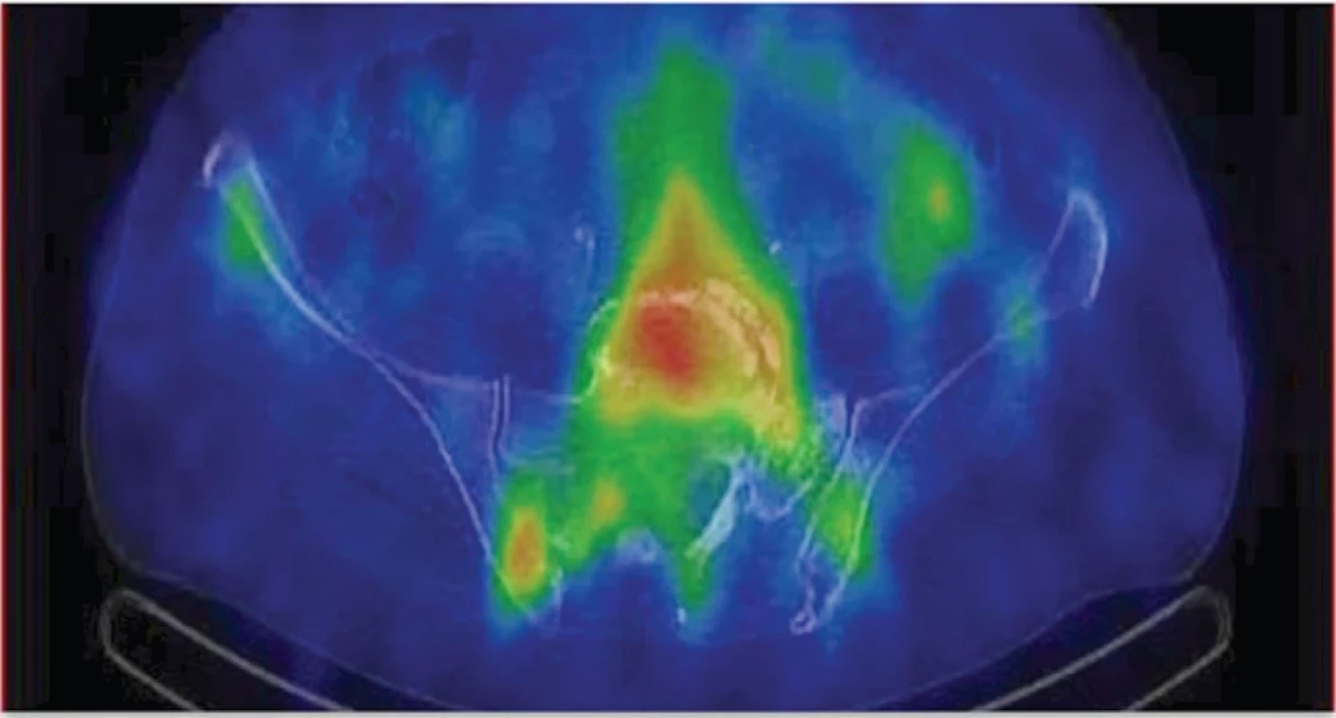 Fúze SPECT/CT pánve v časné fázi v transverzálním řezu – zvýšený krevní pool v oblasti L/S přechodu.
