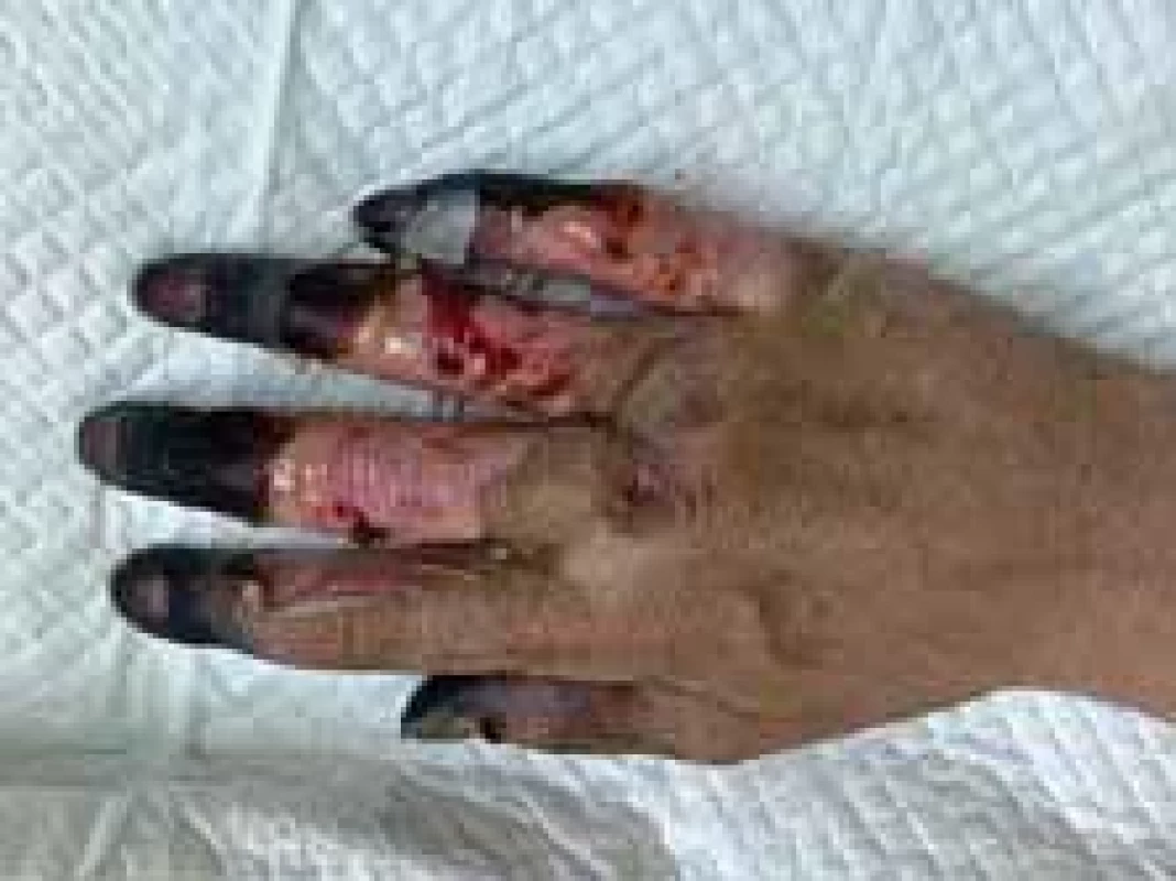 Appearance of right hand (dorsal view).