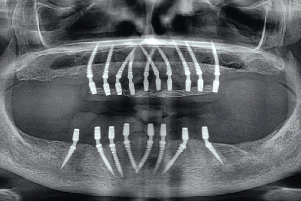 Tranzitorní implantáty nesoucí provizorní pryskyřičné můstky