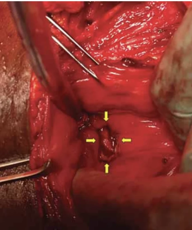 Yellow arrows show the defect in the bladder wall after excision of the fistula margins (published with the patient's permission). // Žluté šipky zobrazují defekt ve stěně močového měchýře po excizi okrajů píštěle (publikováno se svolením pacientky).