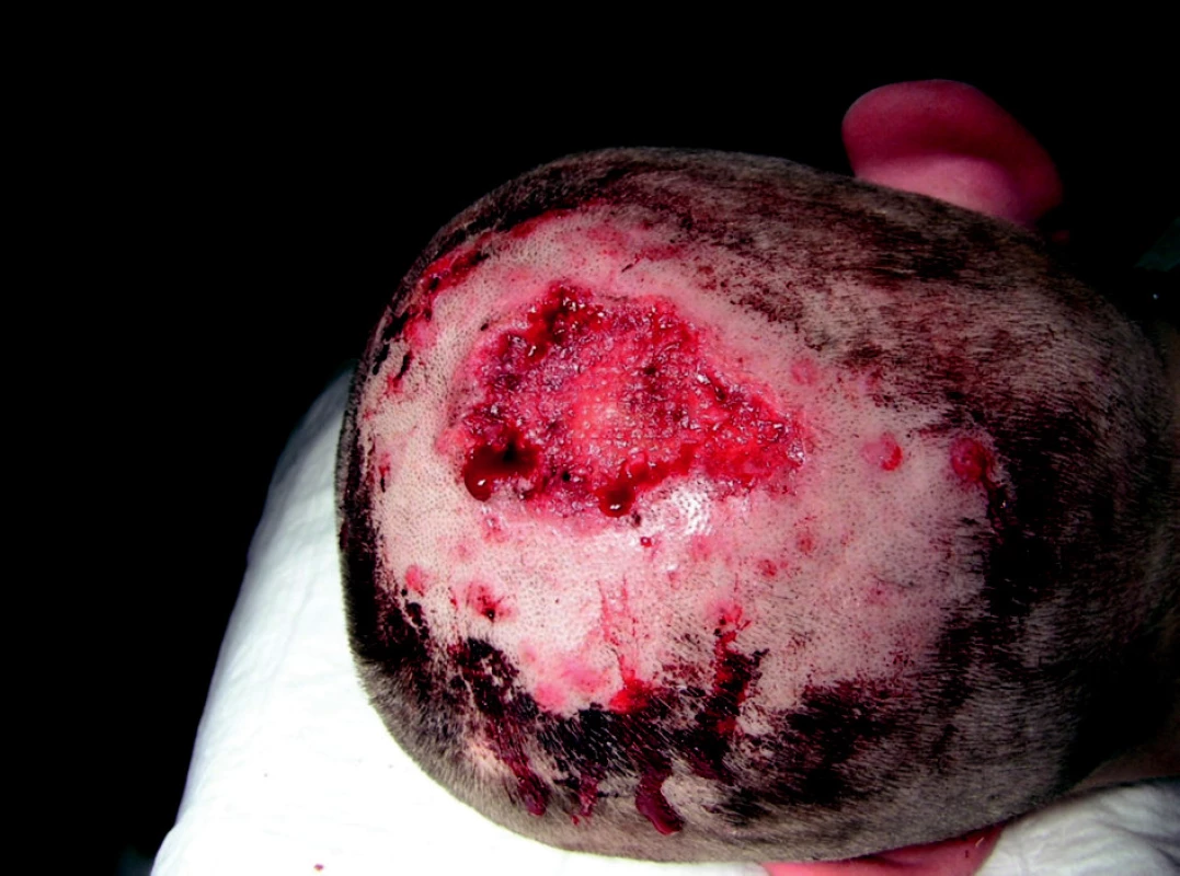 Defekt po snesení nekrotických hmot.
Fig. 1. Defect after removal of necrotic matter.