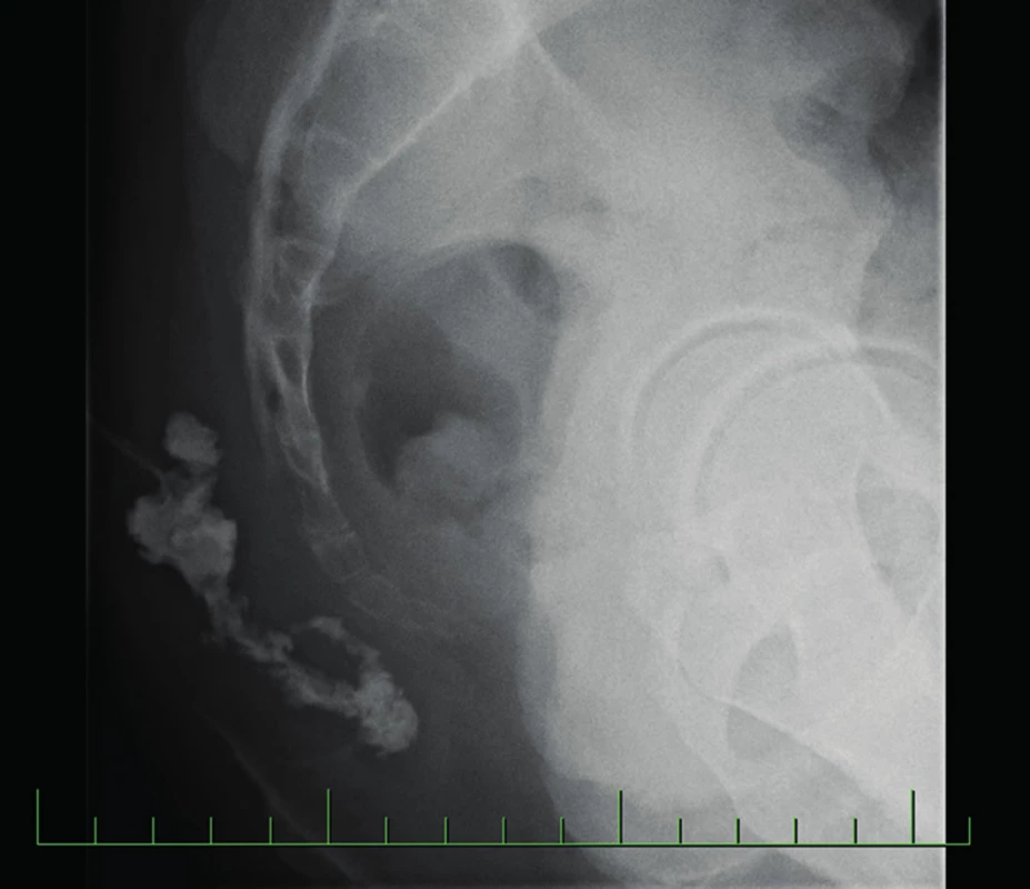 Objemný pilonidální sinus zobrazený fistulografií
Fig. 2: Large pilonidal sinus displayed by fistulography