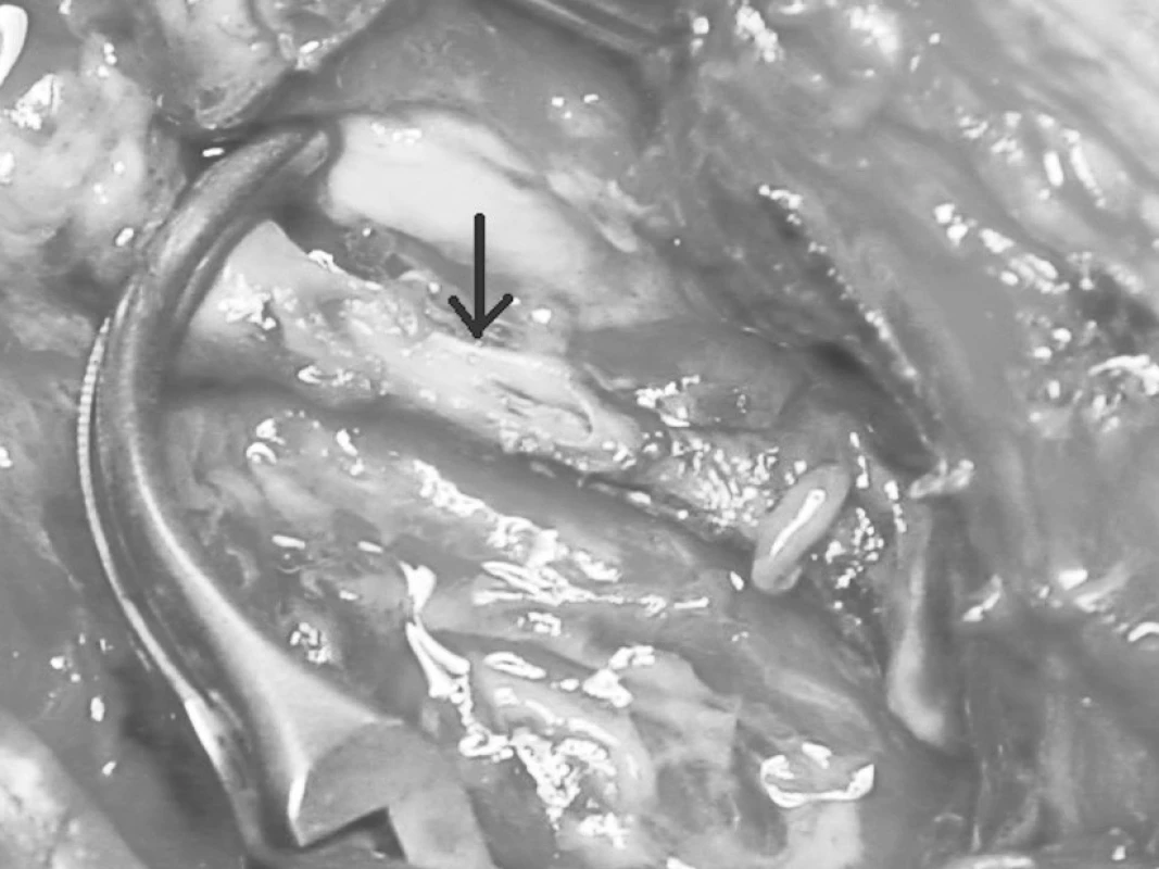 Podrobnější pohled na oblast pseudoaneuryzmatu s poškozením stěny arteria brachialis
Fig. 2. A more detailed view of the pseudoaneurysm with the defect in the arterial wall of the brachial artery