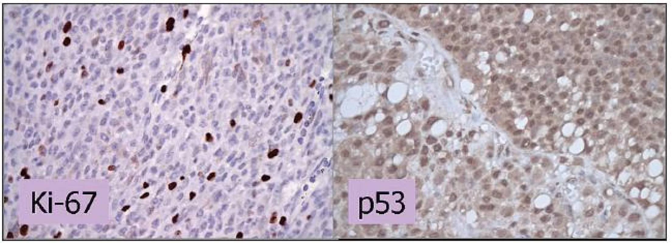 Imunohistochemické vyšetrenie expresie Ki-67 a p53. Vyšetrenie expresie Ki-67 dokumentuje proliferačnú aktivitu MMU. V histologickom preparáte je pozitívnych do 10 % jadier, čo znamená priaznivú prognózu. V prípade p53 predstavuje farbenie jadier v 85% zvýšenú expresiu p53 a svedčí pre menej priaznivú prognózu. Zväčšenie 400x.