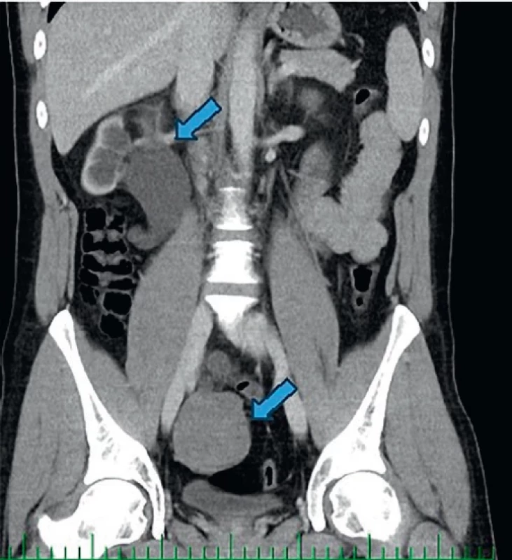 Hydronefróza vpravo, tumor obturující pravý ureter na CT. Hydronephrosis on the right, tumor obstructing the right ureter on CT.
