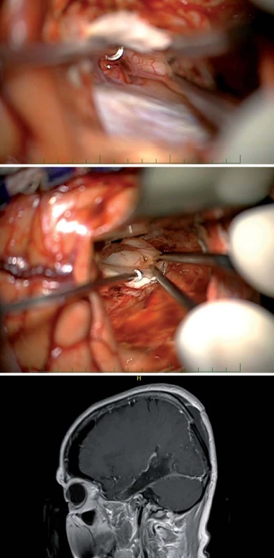 Subokcipitální přístup.
Fig. 8. Suboccipital approach.
Obr. 8a) Mobilizace okcipitálního laloku a identifikace tentoriální incizury.