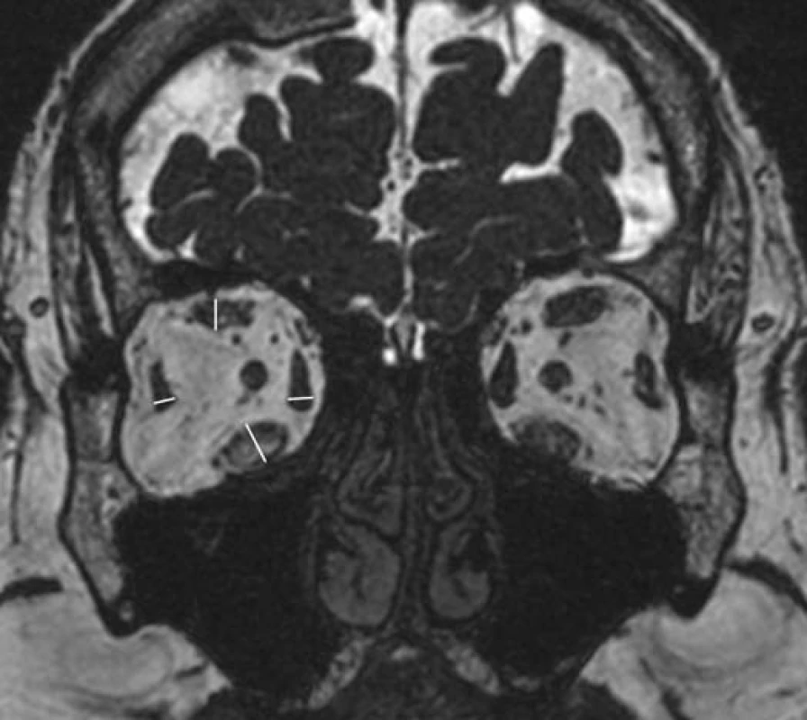 Znázornění měření krátkých průměru okohybných svalů (pro přehlednost znázorněno na jednom MRI skenu). Každý sval byl v praxi měřen v místě své největší šířky na rekonstrukci v rovině kolmé k průběhu dlouhé osy orbity.
