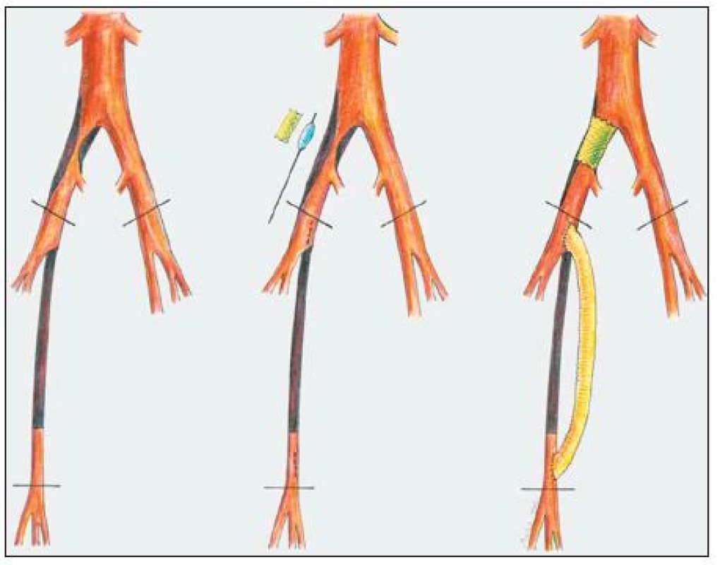 Schéma hybridního výkonu
Fig. 1. A schematic diagram of a hybrid procedure
