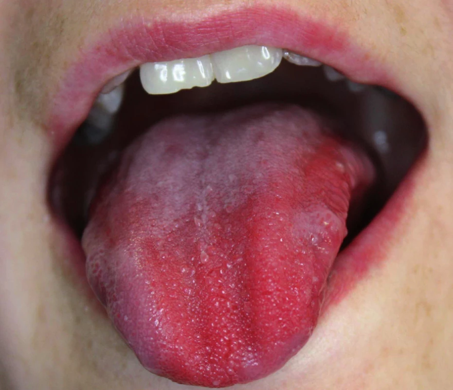 Moellerova-Hunterova glossitida při deficitu vitaminu B<sub>12</sub>