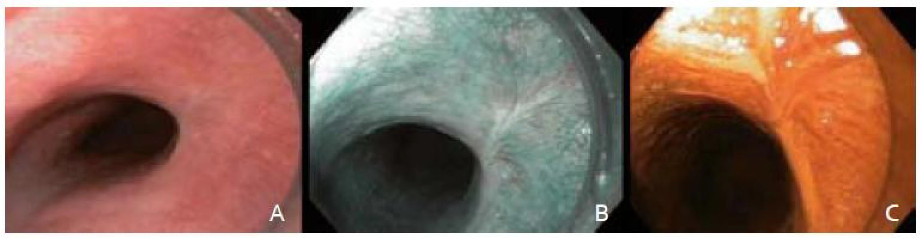 A – zhojená jazva po EMR, B – zobrazenie v NBI, C – farbenie Lugolovym roztokom.
Fig. 5. A – resection scar with white light endocopy, B – narrow band imaging, C – Lugolʹs staining.