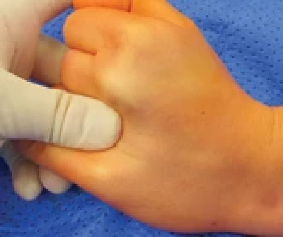 Clinical presentation of brachymetacarpia of the fourth metacarpal in a young female patient.