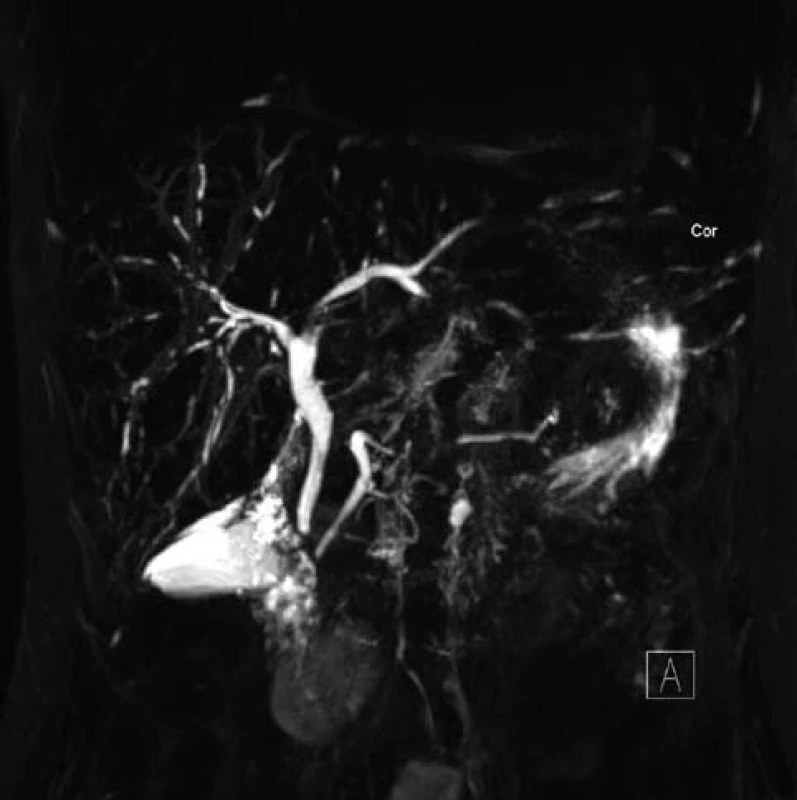 MRC P u první pacientky s typickým obrazem PSC.
Fig. 1. MRCP results of first case with typical PSC profile.