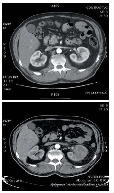 Srovnání CT vyšetření v intervalu 8 měsíců
Fig. 1. The comparison of CT scan during 8 months