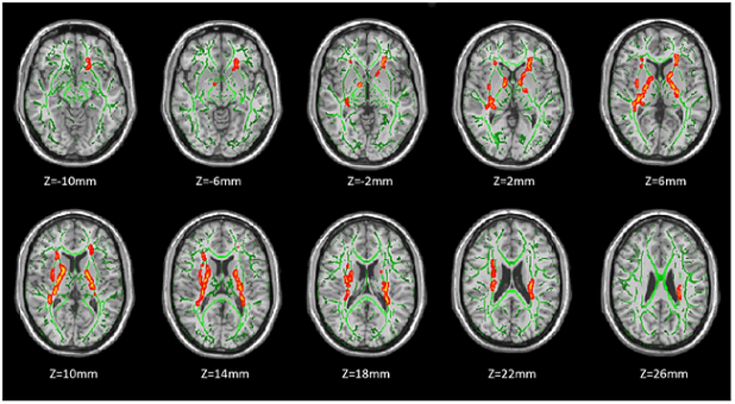 TBSS analysis of fractional anisotropy (FA) between heroin relapsers (HR) and abstainers (HA). Red areas indicate where FA was significantly lower in HR group than in HA group (<i>P</i> < 0.05, corrected by TFCE and FWE). To help visualization, regions with reduced FA (red) were thickened using the ‘tbss_fill’ script implemented in FSL. Green color shows ‘group mean_FA_skeleton’ and the number below each brain image indicates Z coordinate in MNI space. The left side of the image corresponds to the right hemisphere of the brain.