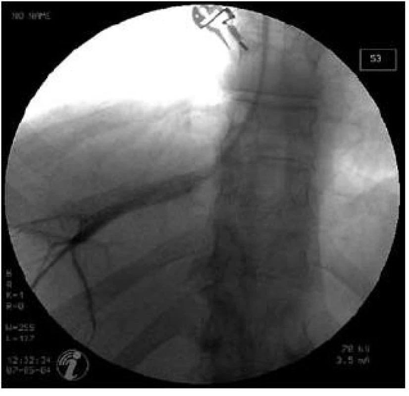 Pozice katétru v jaterní žíle při odečítání FHVP.
Fig. 2. Position of catheter in hepatic vein in FHVP measurement.