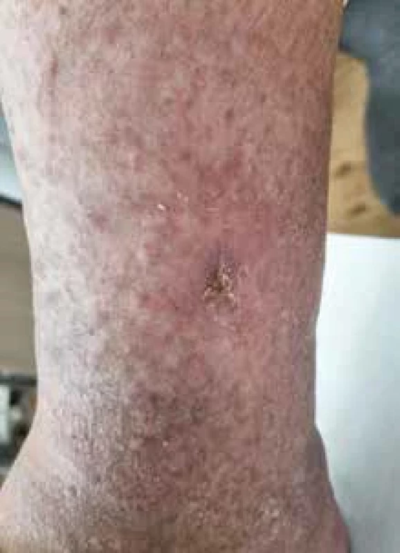 Po 6 týdnech léčby přetrvává tuhý otok bérce, ulcerace zahojeny.