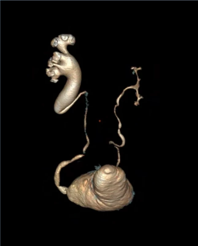 3D rekonstrukce CT urografie znázorňující pravostranný retrokavální ureter. Fig. 2. A 3D reconstruction of CT urography depicting a right-sided retrocaval ureter. 