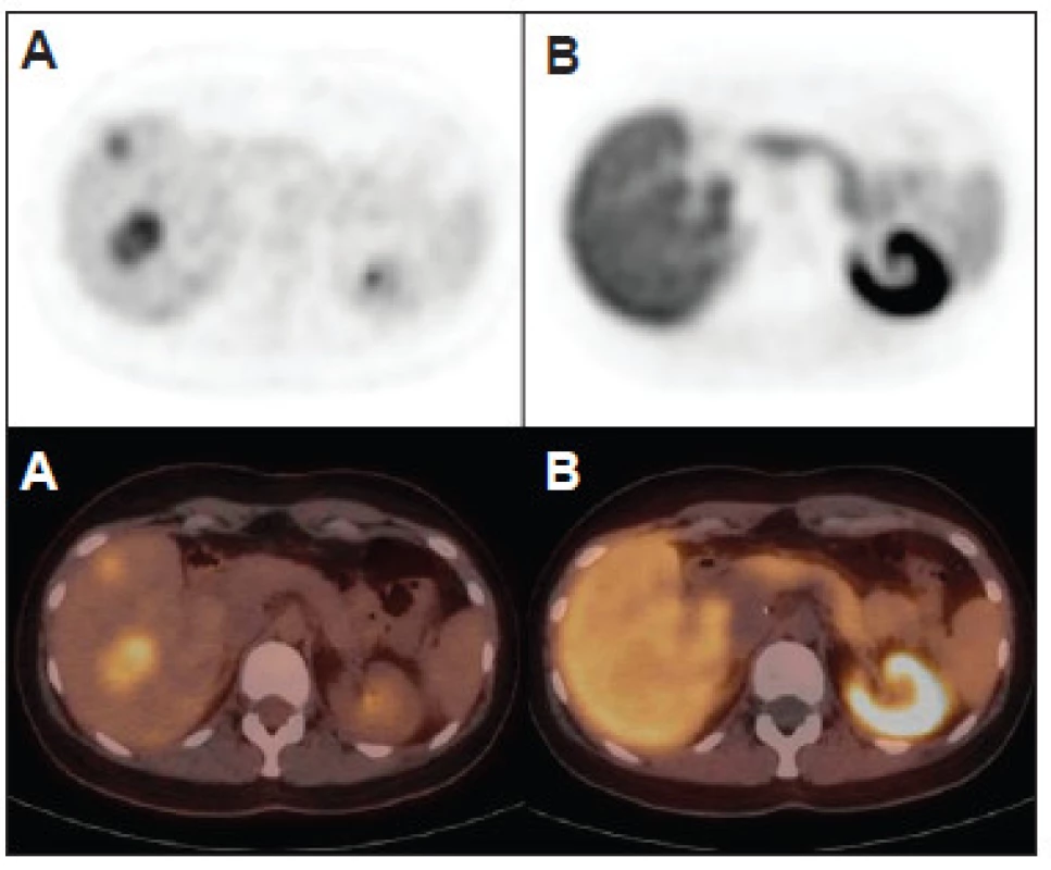 Hepatocelulárny adenóm nemá typický obraz pri PET/CT s FDG a s FCH. Môže byť pozitívny s FDG (A) a nevizualizovaný s FCH (B), ako v tomto prípade pacientky s mnohopočetnou adenomatózou pečene. Hepatocelulárny adenóm je však najčastejšie negatívny s FDG aj s FCH.