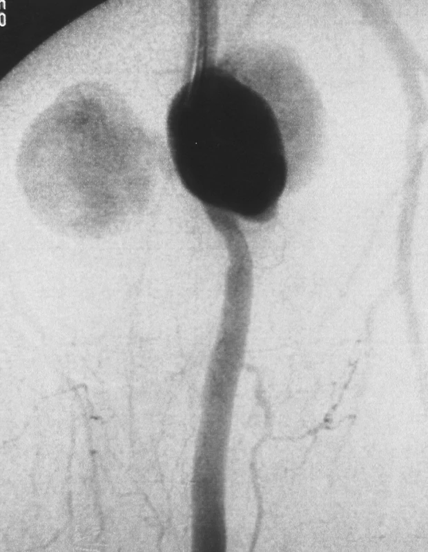 Digitálna subtrakčná angiografia stehna
Pic. 1. Digital subtraction angiography of the thigh