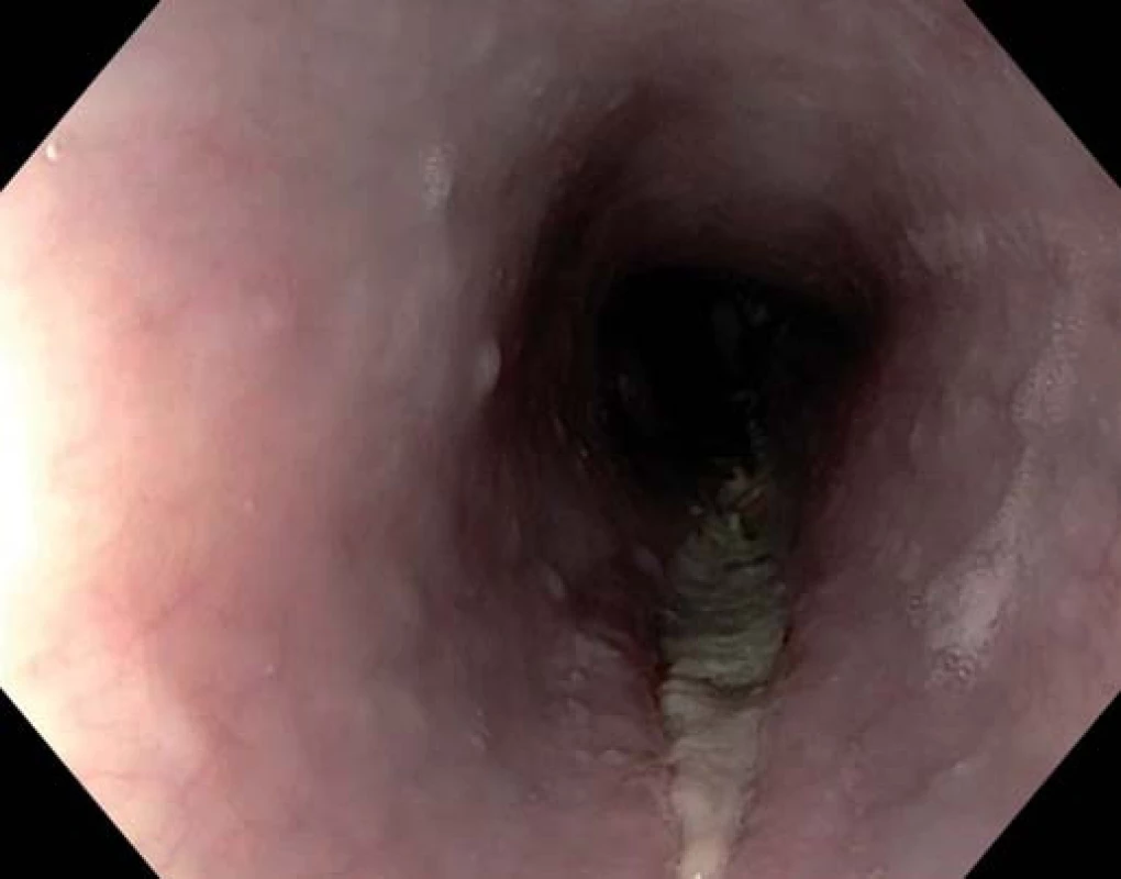 Lacerace jícnu s fibrinovým povlakem.
Fig. 1. Fibrin coating of the oesophageal laceration.