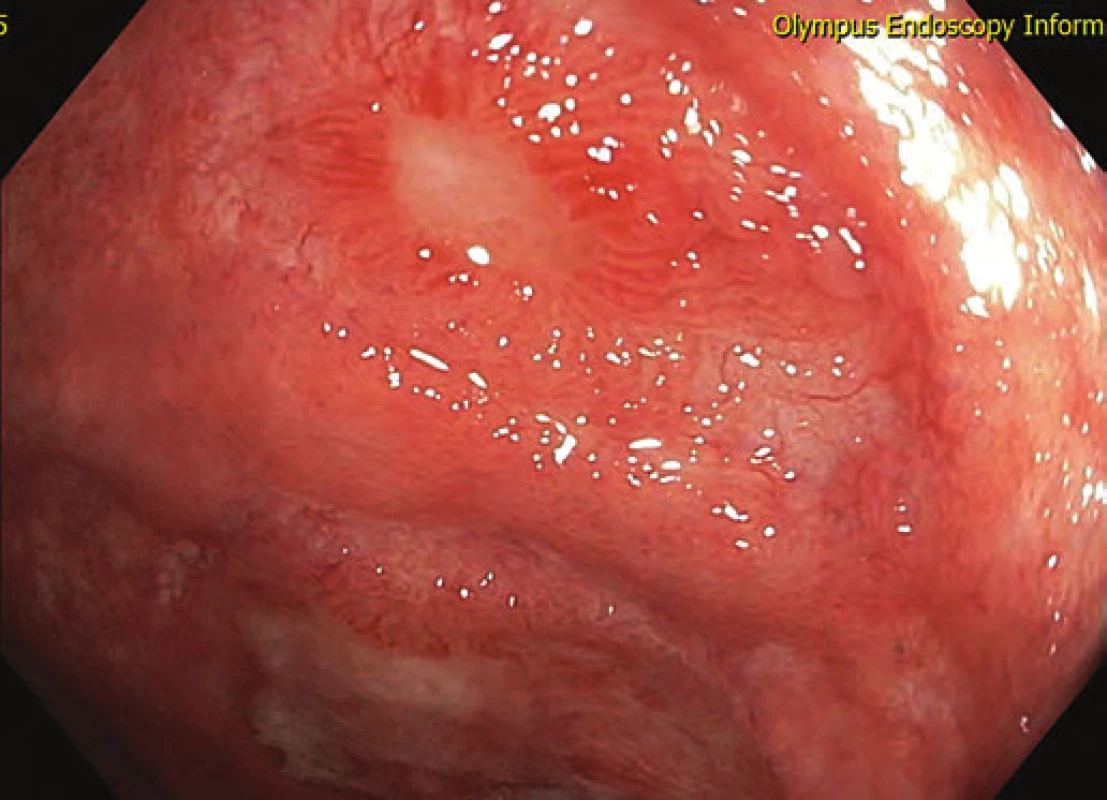 Hojení ulcerací během terapie adalimumabem – bílé světlo.
Fig. 4. Mucosal healing during adalimumab therapy – white light.
