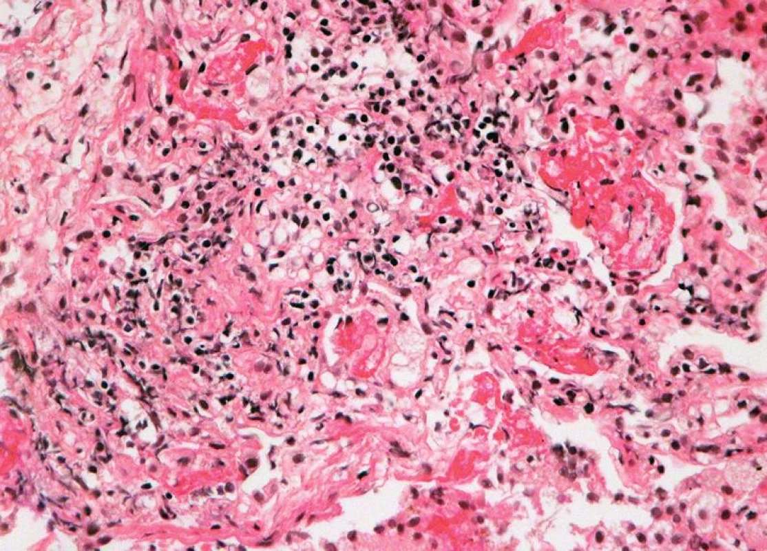 Těžká akutní celulární rejekce, grade A4: difuzní rejekční celulizace s regresí až nekrózou pneumocytů, s fibrinem intraalveolárně (HE, x 400).