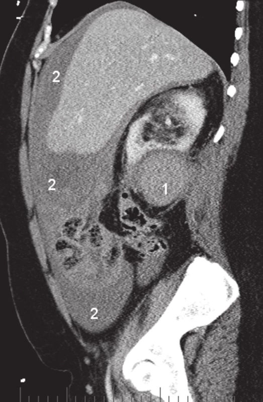Rekonstrukce CT obrazu – tumor pravé ledviny (1) a hemoperitoneum (2)
Fig. 2. Reconstruction of the CT examination – right kidney tumor (1) and the haemoperitoneum (2)