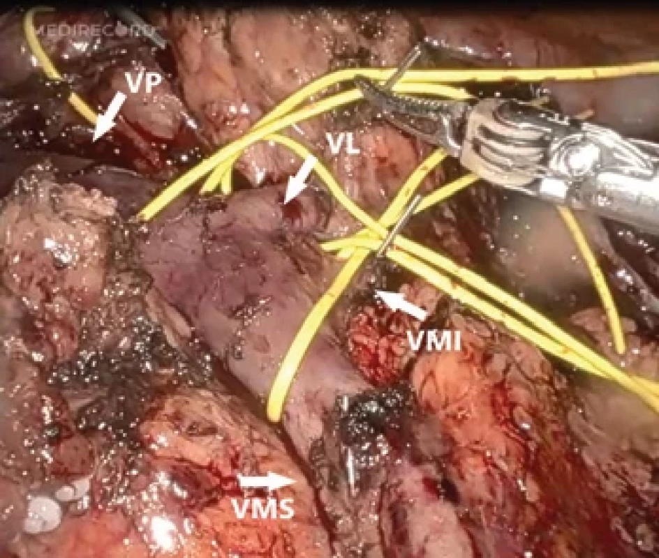 Stav před resekcí portální žíly. Zajištěny jsou všechny přítoky portomesenterického žilního komplexu.</br>Fig. 2. Status before portal vein resection. All tributaries of the portomesenteric venous complex are secured.