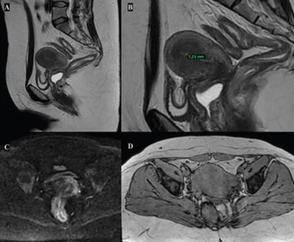 Pelvic magnetic resonance imaging showed a uterus measuring 79 × 44 × 40 mm, with a homogeneous myometrium, no myometrial nodules, and no signs of adenomyosis (A). The endometrium was centrally located, homogeneous, and measured 1.25 mm in thickness (B). The uterine cavity was preserved, with no expansive lesions or disruption of the junctional zone (C and D). Obr. 2. Magnetická rezonance pánve ukázala dělohu o rozměrech 79 × 44 × 40 mm s homogenním myometriem, bez myometrických uzlíků a bez známek adenomyózy (A). Endometrium bylo centrálně umístěno, homogenní a měřilo 1,25 mm na tloušťku (B). Dutina děložní byla zachována, bez rozsáhlých lézí nebo narušení junkční zóny (C a D).