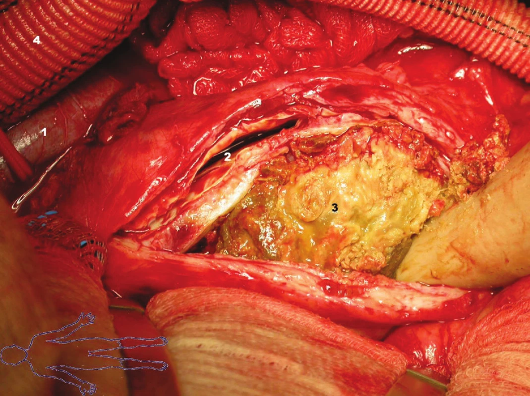Stav po otevření vaku výdutě:
1 – vena cava inferior
2 – pravé lumen břišní aorty
3 – falešné lumen vyplněné trombotickými hmotami
4 – bifurkační protéza
Fig. 3. St. p. the aneurysmal sac opening:
1 – vena cava inferior
2 – right lumen of the abdominal aorta
3 – fals lumen filled with thrombotic masses
4 – bifurcated prosthesis
