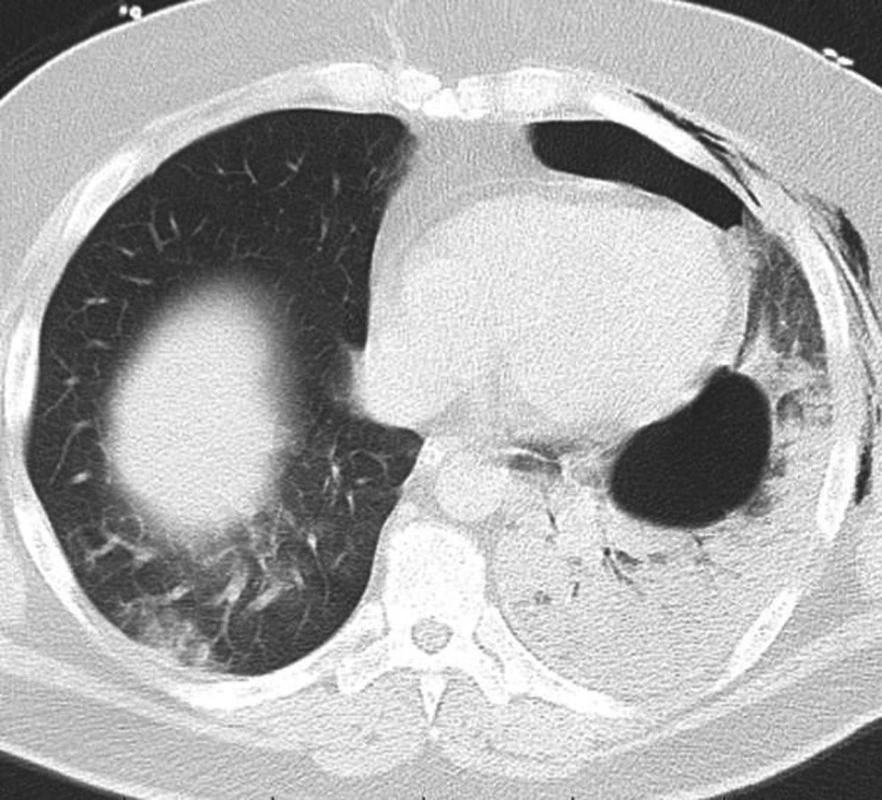 CT vyšetření hrudníku odhalující difúzní konsolidaci plicní tkáně vlevo s bulou lokalizovanou v dolním laloku
Fig. 2: CT scan of the thorax showing diffuse consolidation of the left lung tissue with a bulla localized in the left lower lobe