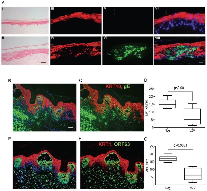 VZV downregulated <i>KRT1/10</i> expression in the epidermis.