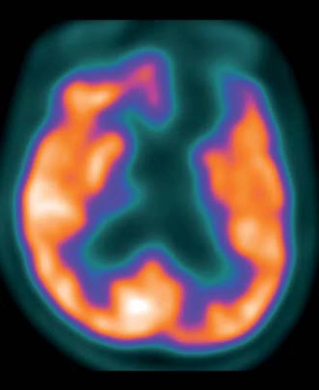Subtrakční zobrazení FDG PET/CT po podání zolpidemu.
Fig. 2. Subtraction FDG PET CT scan following zolpidem administration.