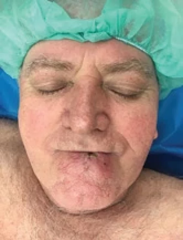 Recurrence of lower lip cancer.