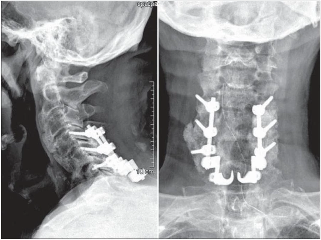 Radiologický nález po první operaci: zadní stabilizace užívá fixaci laterálních mas C4, C5 a C6 a sublaminární háčky C7 k tomu, aby zajistila neutrální anatomické postavení krční páteře.
